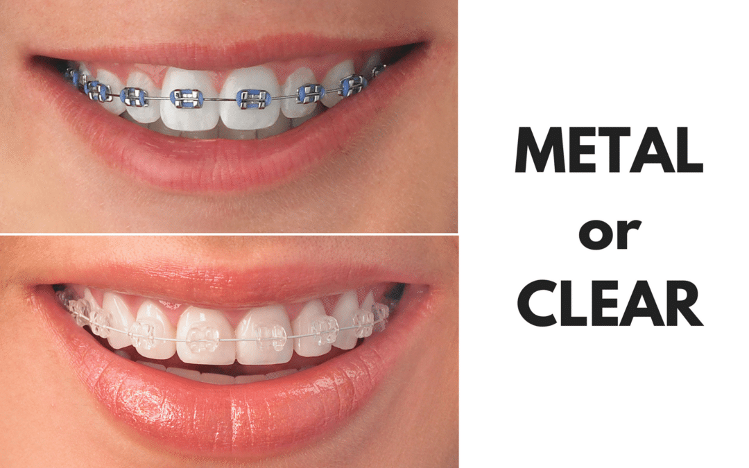 Ask Your Victoria TX Dentist: Should I Get Metal or Clear Braces?