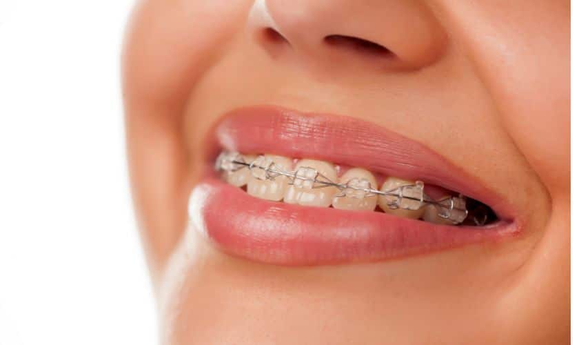 How to Eat and Speak Confidently with Braces in Victoria, TX