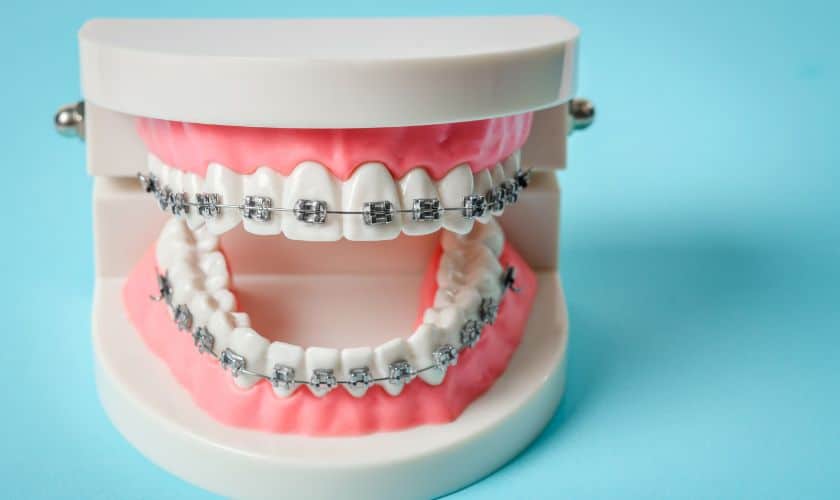 Can Braces Cause Damage to Teeth or Gums?