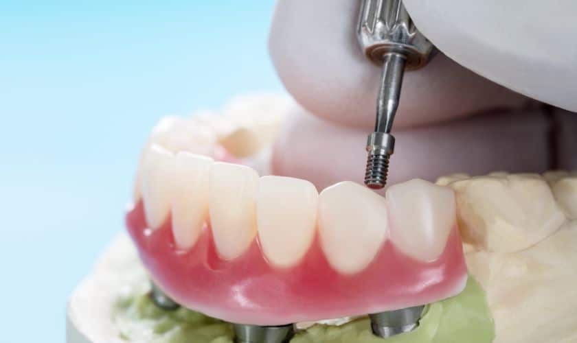 Navigating the Journey: A Comprehensive Guide to the Dental Implant Procedure