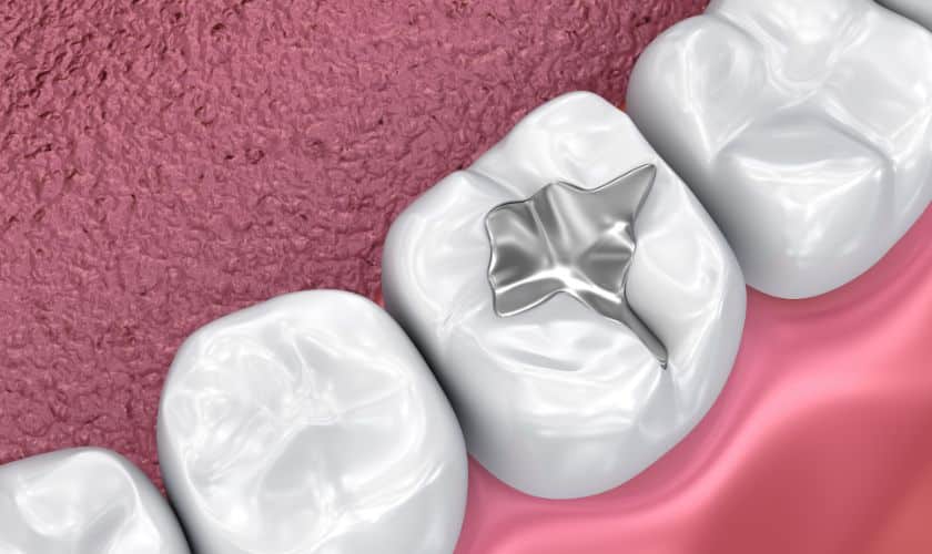 Sealing the Deal: Should Adults Get Dental Sealants?