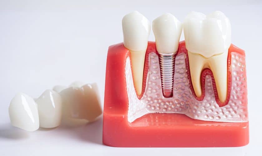 When Does a Tooth Need a Root Canal?