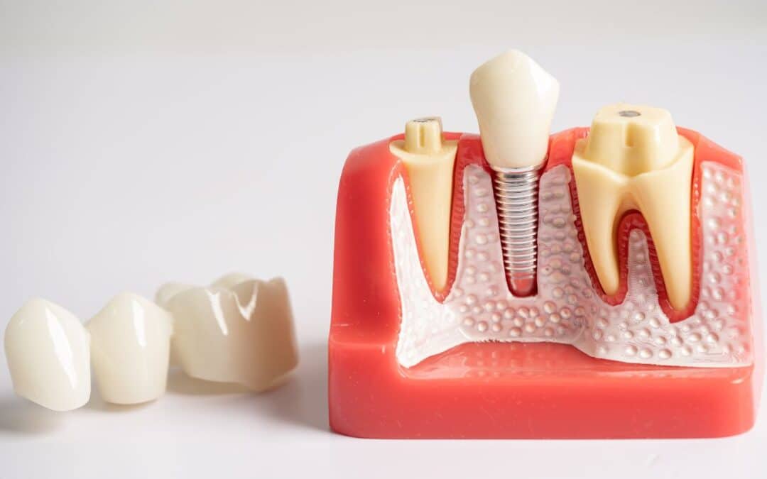 The Impact of Dental Implants on Quality of Life