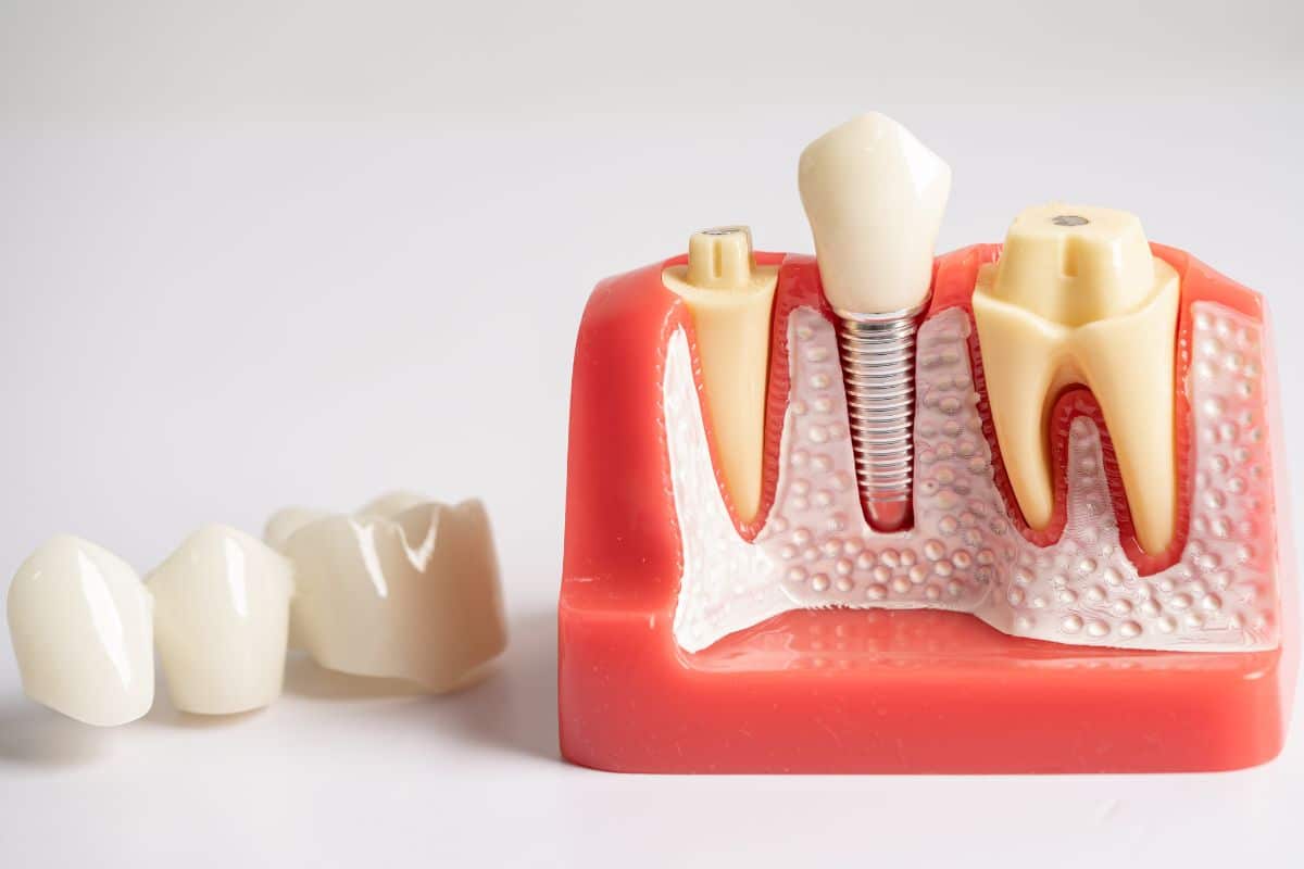 dental-implants dental implants